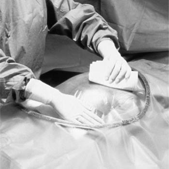 3M Steri-Drape Cesarean-Section Sheets & Pouches Case 6697 By 3M H